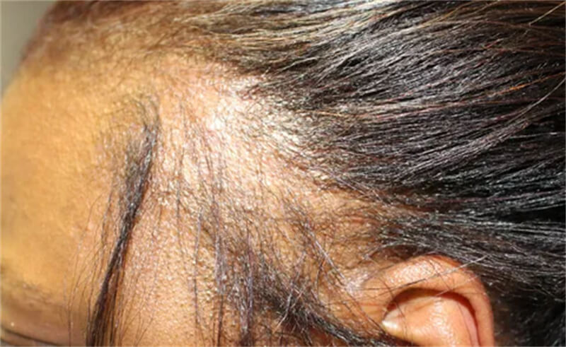 What Is Traction Alopecia